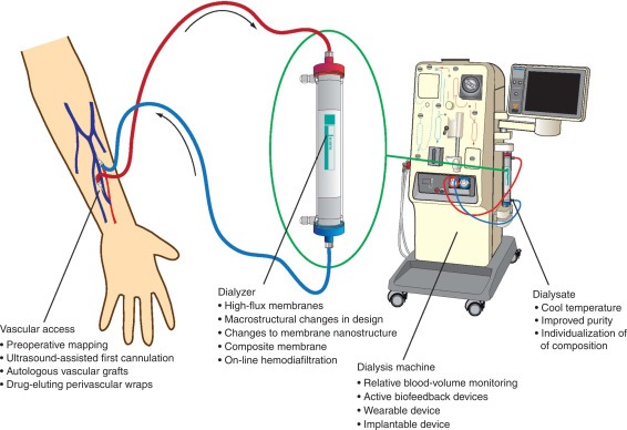 hemodialysis process