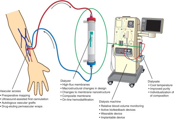 hemodialysis process